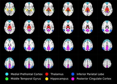 Disrupted Thalamus White Matter Anatomy and Posterior Default Mode Network Effective Connectivity in Amnestic Mild Cognitive Impairment